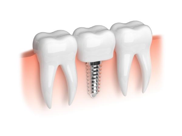 dental implants near me North Ealing