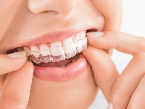 invisalign ealing expert clear brace